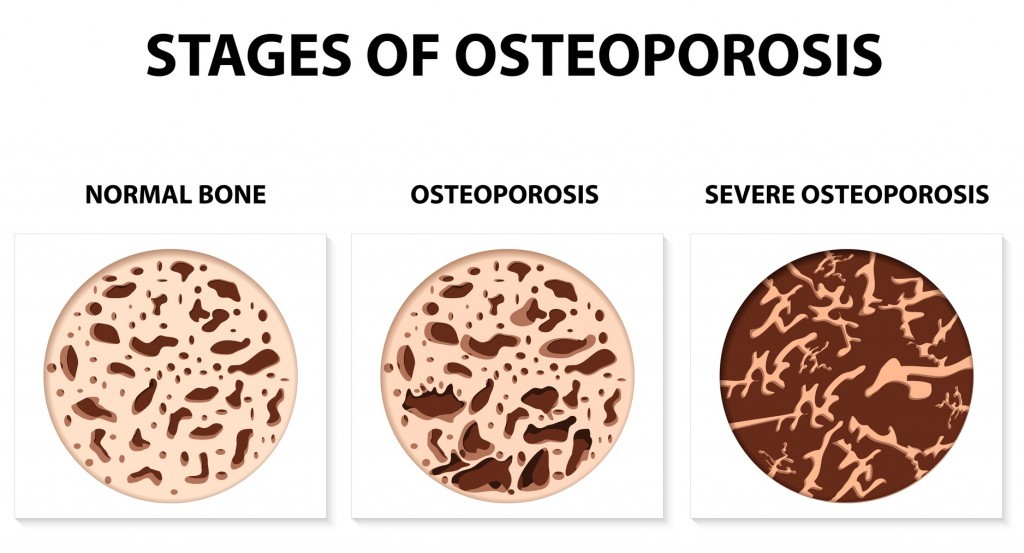 Stages of Osteoporosis