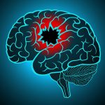 Brain Stroke