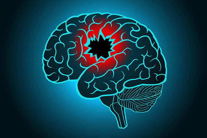 Brain Stroke